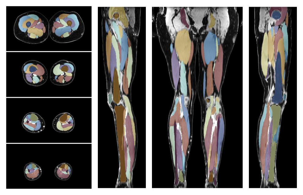 Overlay of automated muscle segmentation labels on dixon water image.